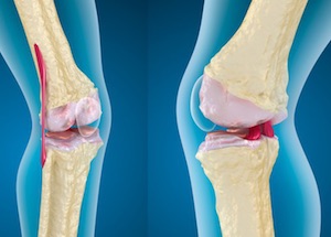 остеоартроз коленных суставов